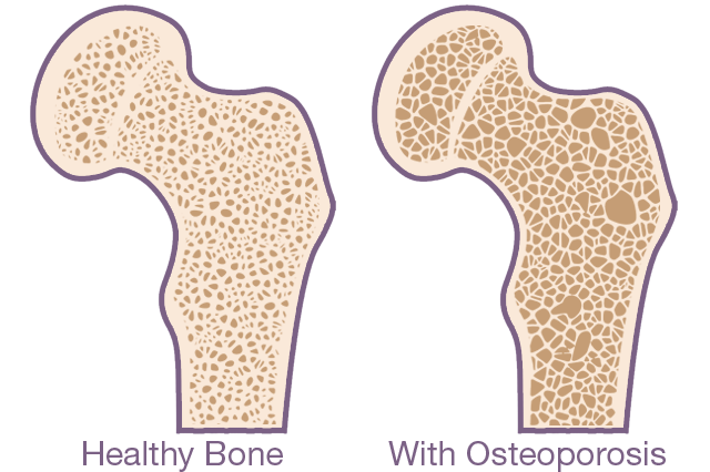 Osteoporosis - A Pediatric Disease In Geriatric Clothes ...
